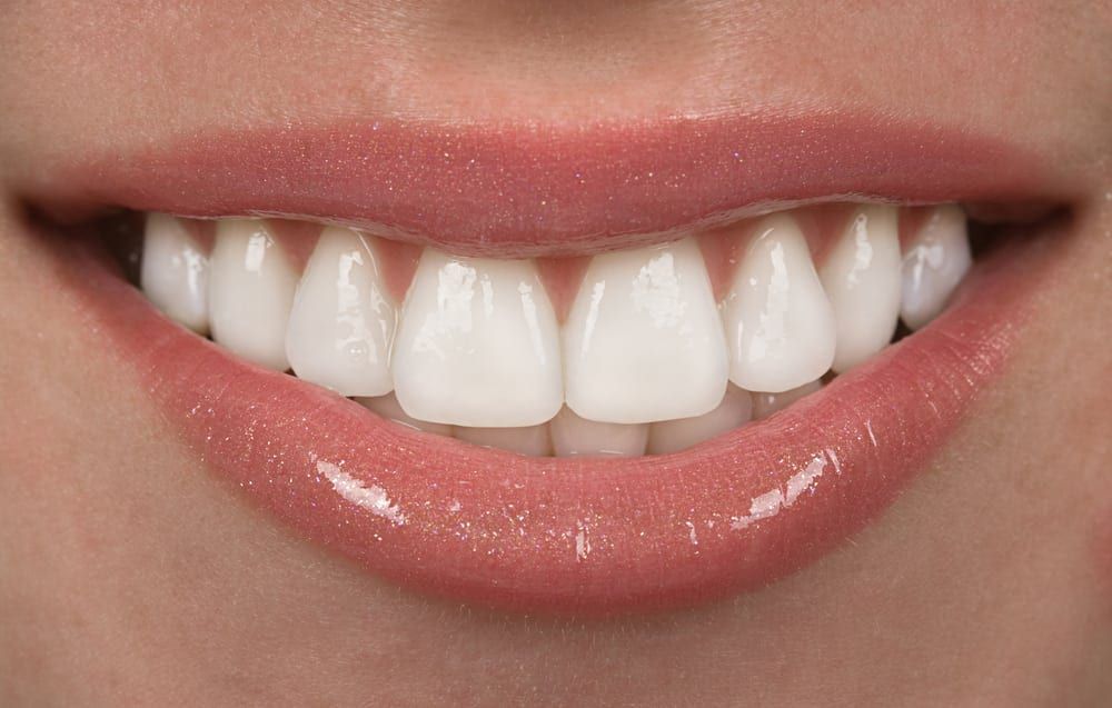 Picture of lady smiling with bright white teeth